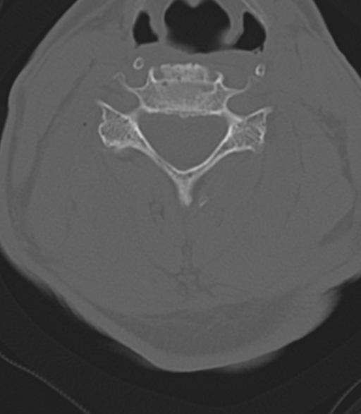 Cervical spine fractures with vertebral artery dissection (Radiopaedia 53296-59268 Axial bone window 31).png