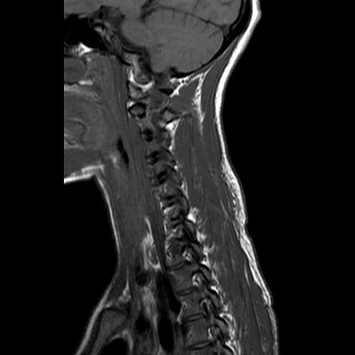 File:Cervical spine posterior ligamentous complex rupture (Radiopaedia 63486-72103 Sagittal T1 10).jpg