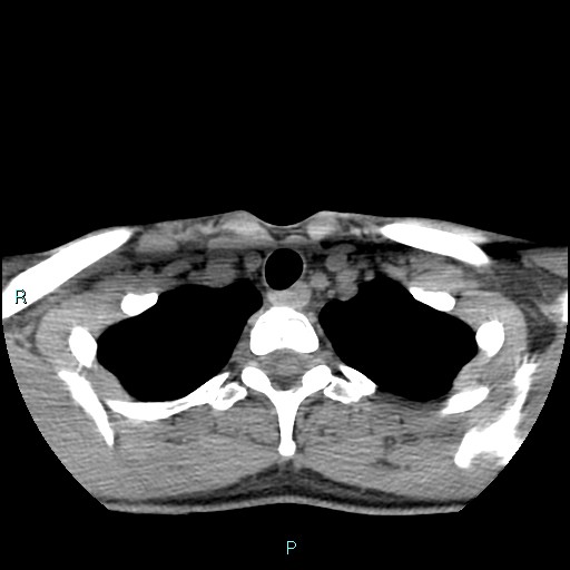 File:Cervical thymic cyst (Radiopaedia 88632-105335 Axial non-contrast 28).jpg