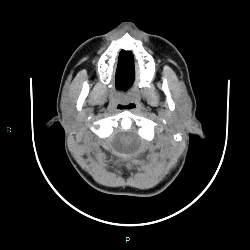 File:Cervical thymic cyst (Radiopaedia 88632-105335 Axial non-contrast 96).jpg