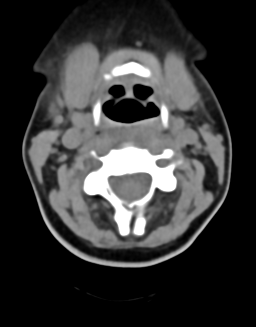 Cervical tuberculous spondylitis (Radiopaedia 39149-41365 Axial non-contrast 20).png