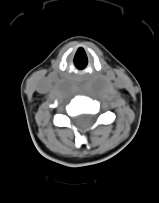 Cervical tuberculous spondylitis (Radiopaedia 39149-41365 Axial non-contrast 28).png