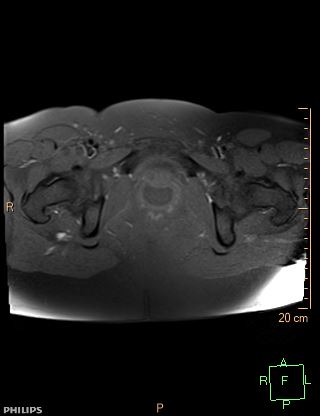 File:Cesarian scar endometriosis (Radiopaedia 68495-78066 Axial T1 fat sat 22).jpg