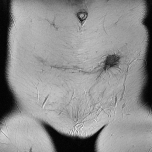File:Cesarian section scar endometriosis (Radiopaedia 66520-75799 Coronal T2 3).jpg