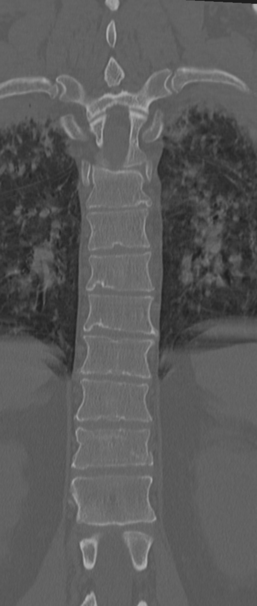 Chance fracture (Radiopaedia 33854-35020 Coronal bone window 52).png