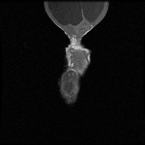 File:Chiari II malformation with spinal meningomyelocele (Radiopaedia 23550-23652 Coronal T1 10).jpg