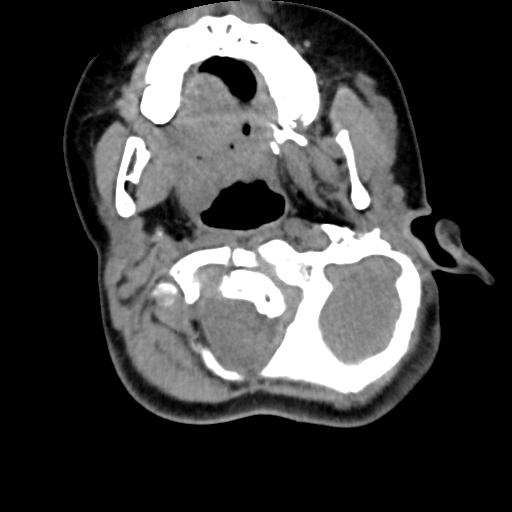 Chiari I with syrinx and skull base anomalies (Radiopaedia 89444-106412 Axial non-contrast 46).jpg