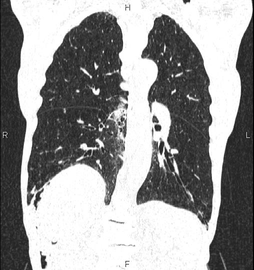 Chilaiditi sign (Radiopaedia 88839-105611 Coronal lung window 41).jpg