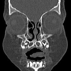 Choanal atresia (Radiopaedia 88525-105975 Coronal bone window 8).jpg
