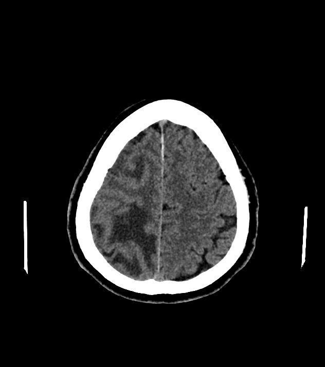 Cholangiocarcinoma with cerebral metastases (Radiopaedia 83519-98628 Axial non-contrast 53).jpg