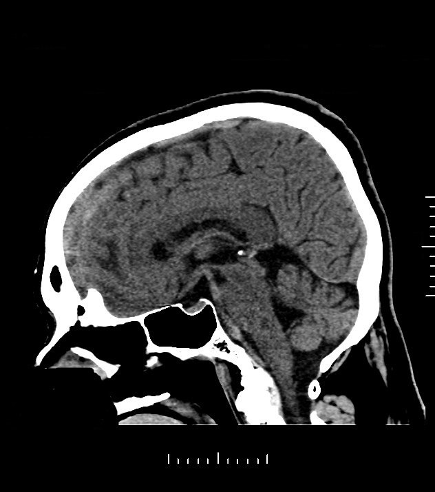 Cholangiocarcinoma with cerebral metastases (Radiopaedia 83519-98628 C 28).jpg