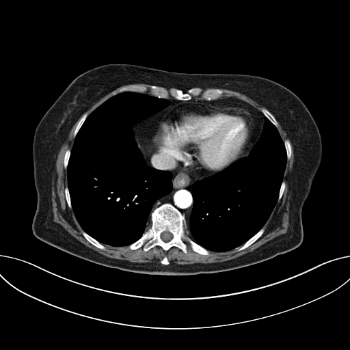 Cholecystoduodenal fistula due to calculous cholecystitis with gallstone migration (Radiopaedia 86875-103077 A 7).jpg