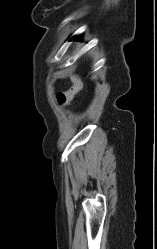 Cholecystoduodenal fistula due to calculous cholecystitis with gallstone migration (Radiopaedia 86875-103077 C 4).jpg