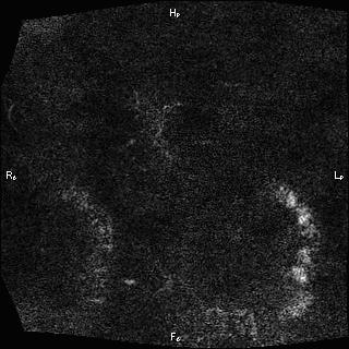Choledochal cyst - type Ia (Radiopaedia 85673-101454 F 2).jpg