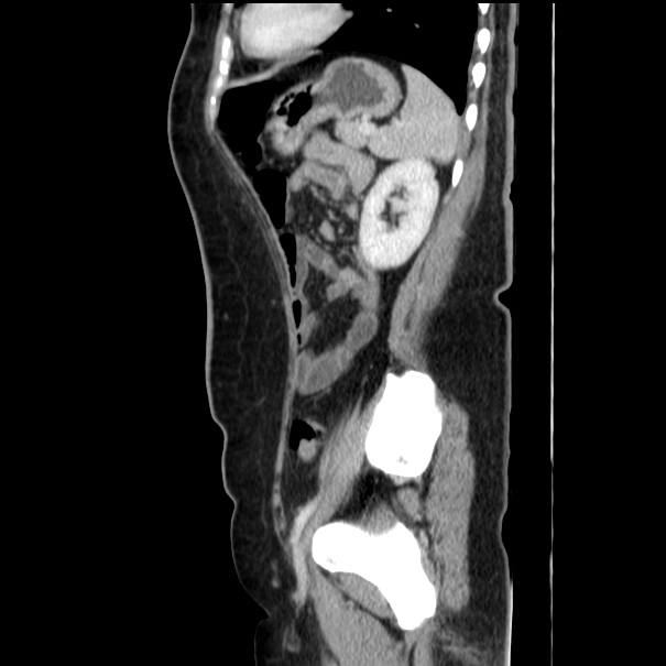 Choledocholithiasis on CT and MRI (Radiopaedia 24825-25087 D 46).jpg
