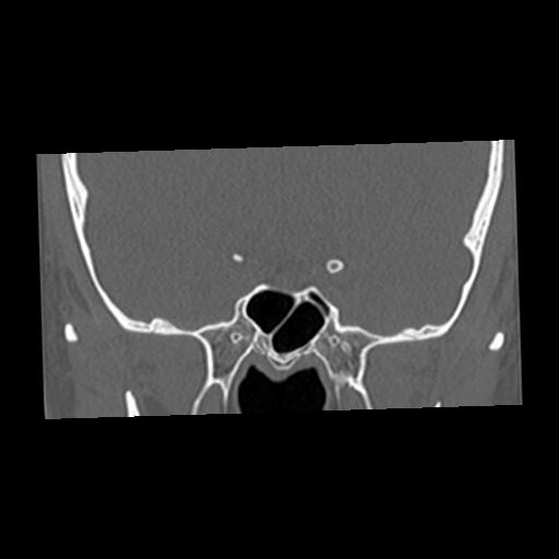 Cholesteatoma (Radiopaedia 84960-100474 Coronal bone window 4).jpg