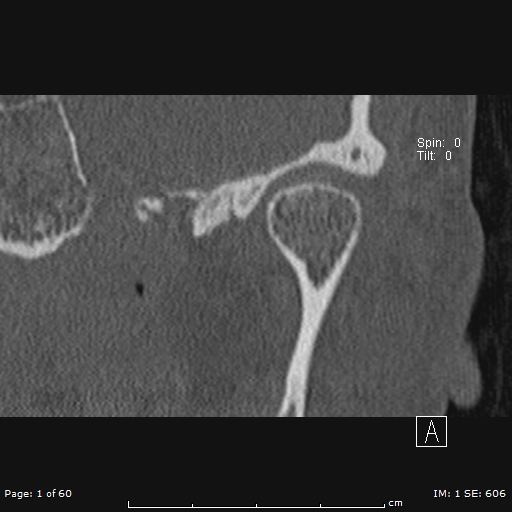 Cholesteatoma - external auditory canal (Radiopaedia 88452-105096 Coronal bone window 1).jpg