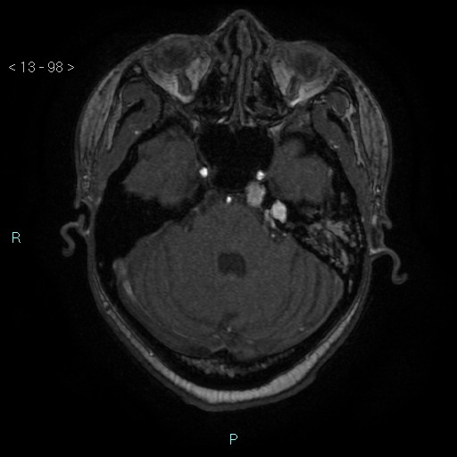 Cholesterol granuloma of the petrous apex (Radiopaedia 64358-73140 Axial TOF 3D 47).jpg