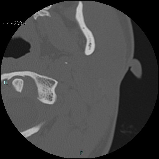 Cholesterol granuloma of the petrous apex (Radiopaedia 64358-73141 Axial bone window 98).jpg