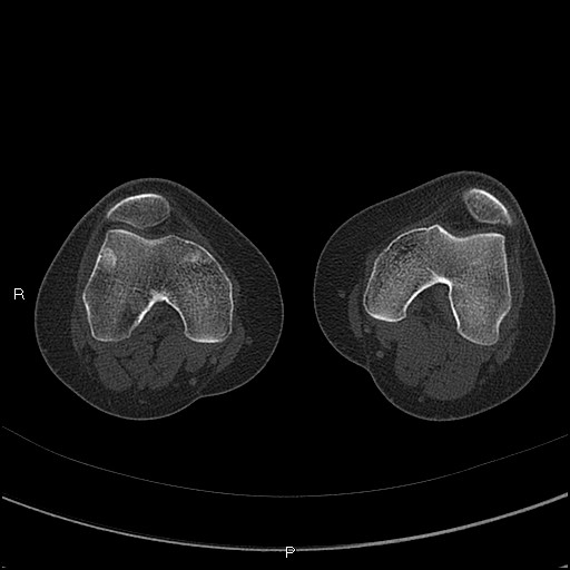 File:Chondroblastoma (Radiopaedia 62721-71030 Axial bone window 12).jpg