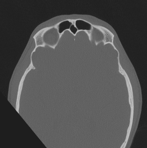 File:Chondrosarcoma (clivus) (Radiopaedia 46895-51425 Axial bone window 9).png
