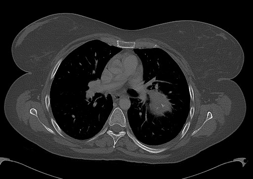 File:Chondrosarcoma - chest wall (Radiopaedia 65192-74199 Axial bone window 56).jpg