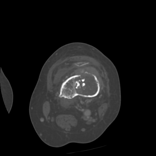 Chondrosarcoma - femur (Radiopaedia 64187-72954 Axial bone window 28).jpg