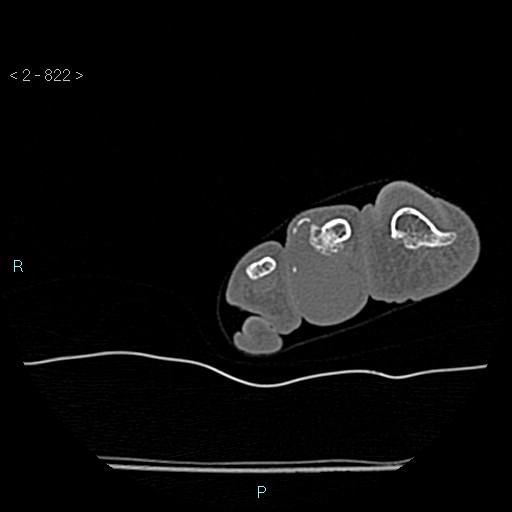 Chondrosarcoma - phalanx (Radiopaedia 69047-78812 Axial bone window 76).jpg