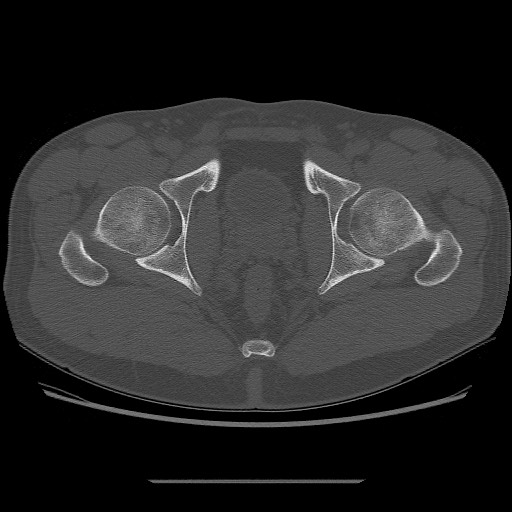 File:Chondrosarcoma of iliac wing (Radiopaedia 63861-72599 Axial bone window 106).jpg