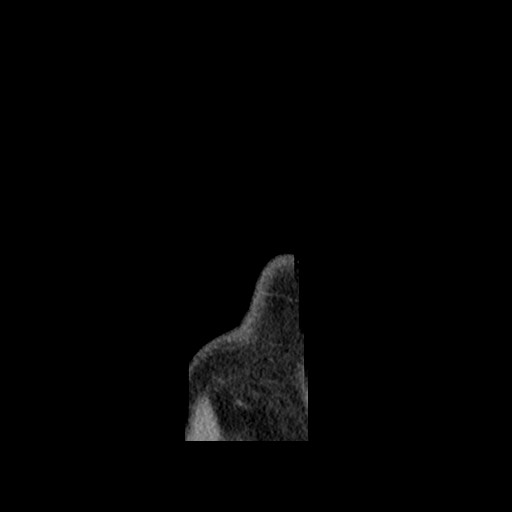 Chondrosarcoma of iliac wing (Radiopaedia 63861-72599 F 180).jpg