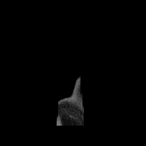 Chondrosarcoma of iliac wing (Radiopaedia 63861-72599 F 181).jpg