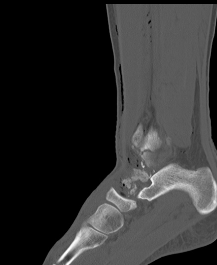 Chopart fracture (Radiopaedia 35347-36851 Sagittal bone window 39).jpg