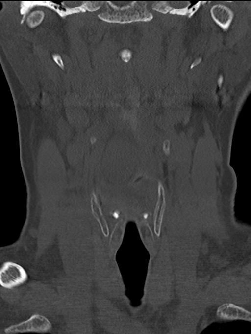 Chordoma (C4 vertebra) (Radiopaedia 47561-52188 Coronal bone window 8).png