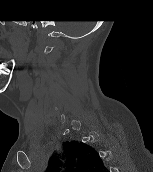File:Chordoma (C4 vertebra) (Radiopaedia 47561-52188 Sagittal bone window 19).png