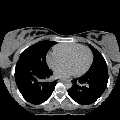 File:Choriocarcinoma of ovary with cerebral and pulmonary metastases (Radiopaedia 25983-26119 Axial non-contrast 157).jpg