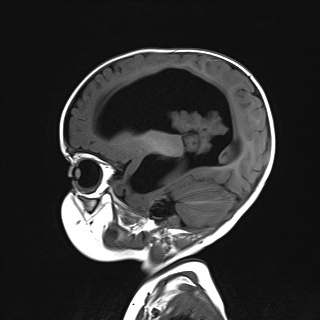 File:Choroid plexus papilloma (Radiopaedia 84612-100019 Sagittal T1 6).jpg