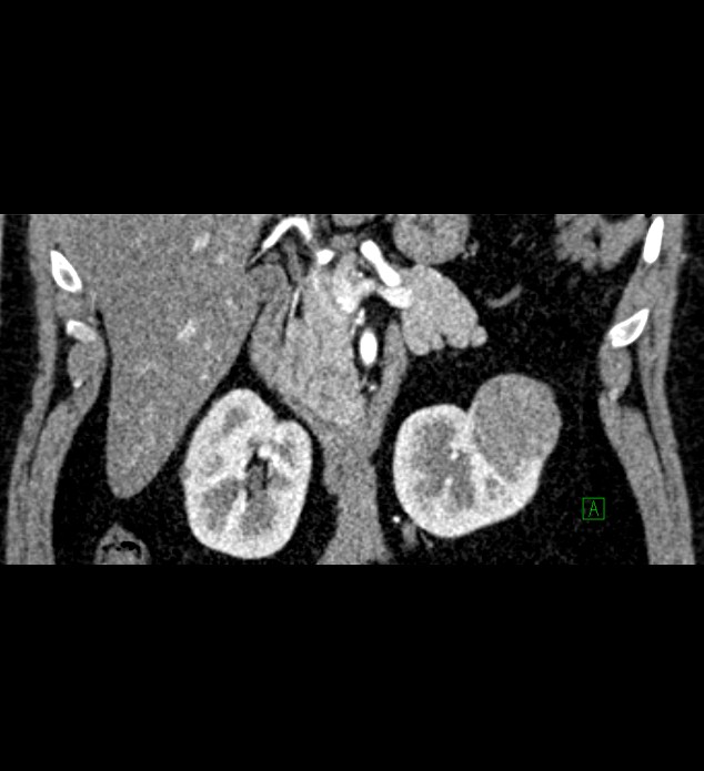 Chromophobe renal cell carcinoma (Radiopaedia 84286-99573 E 27).jpg