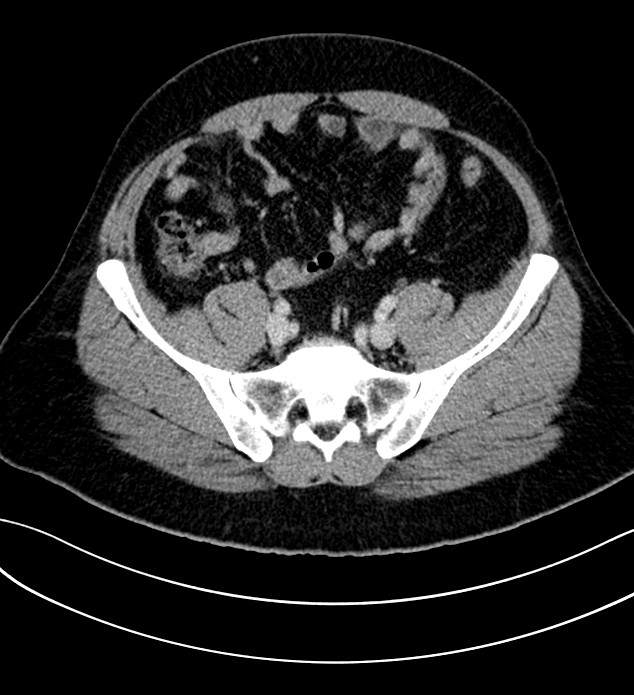 Chromophobe renal cell carcinoma (Radiopaedia 84286-99573 G 54).jpg