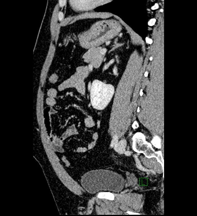 Chromophobe renal cell carcinoma (Radiopaedia 84286-99573 I 68).jpg