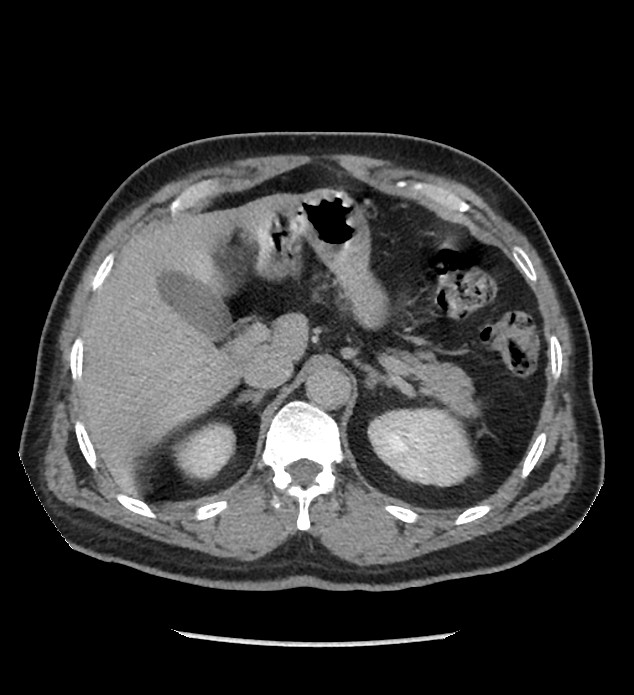 Chromophobe renal cell carcinoma (Radiopaedia 86879-103083 D 35).jpg