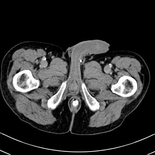 Chronic appendicitis complicated by appendicular abscess, pylephlebitis and liver abscess (Radiopaedia 54483-60700 B 159).jpg