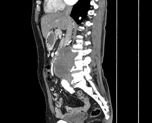 File:Chronic contained rupture of abdominal aortic aneurysm with extensive erosion of the vertebral bodies (Radiopaedia 55450-61901 B 21).jpg