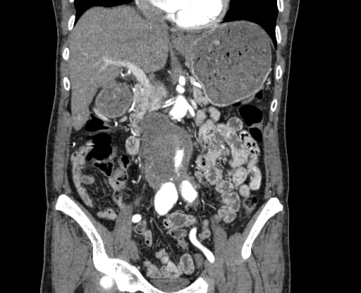 Chronic contained rupture of abdominal aortic aneurysm with extensive erosion of the vertebral bodies (Radiopaedia 55450-61901 D 29).jpg