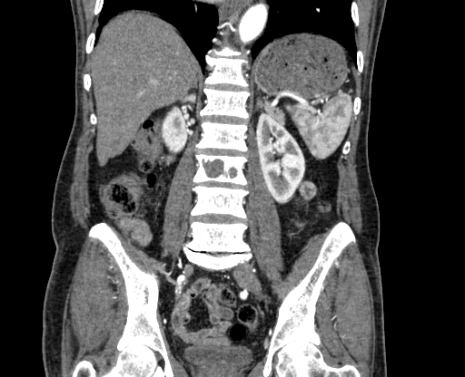 Chronic contained rupture of abdominal aortic aneurysm with extensive erosion of the vertebral bodies (Radiopaedia 55450-61901 D 50).jpg