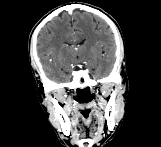 Chronic invasive fungal sinusitis with intraorbital and intracranial extension (Radiopaedia 56387-63046 C 197).jpg