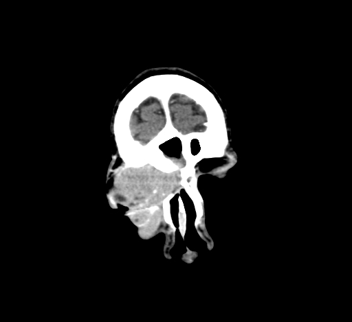 Chronic invasive fungal sinusitis with intraorbital and intracranial extension (Radiopaedia 56387-63046 C 47).jpg
