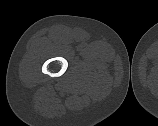 File:Chronic ostemyelitis of the femur with long sinus tract (Radiopaedia 74947-85982 Axial bone window 47).jpg