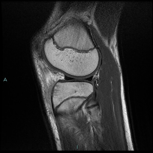 File:Chronic osteomyelitis (with Brodie abscess) (Radiopaedia 76405-88112 Sagittal PD 20).jpg