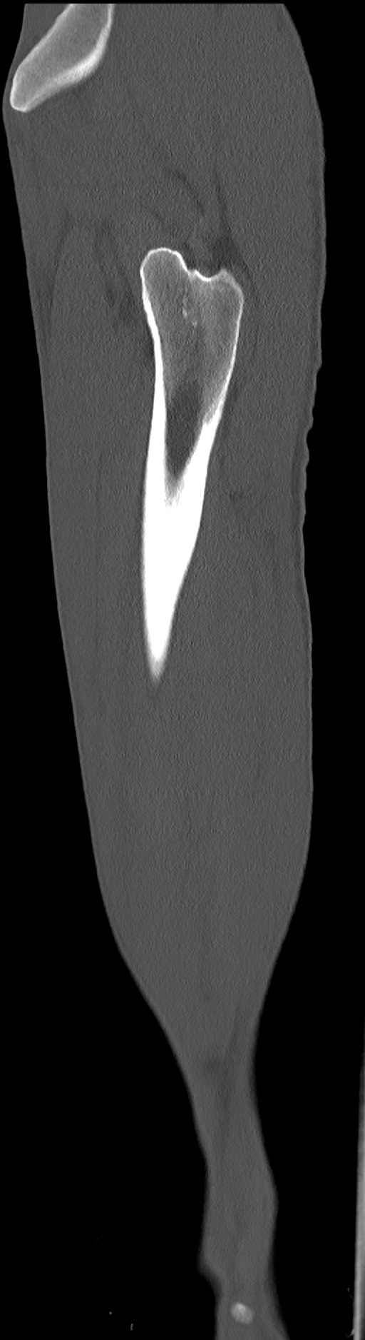 Chronic osteomyelitis (with sequestrum) (Radiopaedia 74813-85822 C 20).jpg