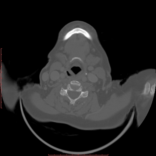Chronic osteomyelitis - maxilla (Radiopaedia 23783-23927 Axial bone window 4).jpg